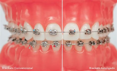 brackets metalicos autoligados|brackets autoligables beneficios.